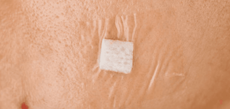 Pilihan Acne Patch Derma Angel yang Efektif Atasi Jerawat